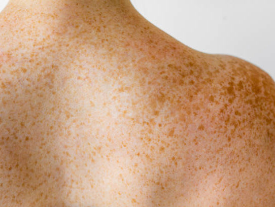 Sunspots vs. Freckles