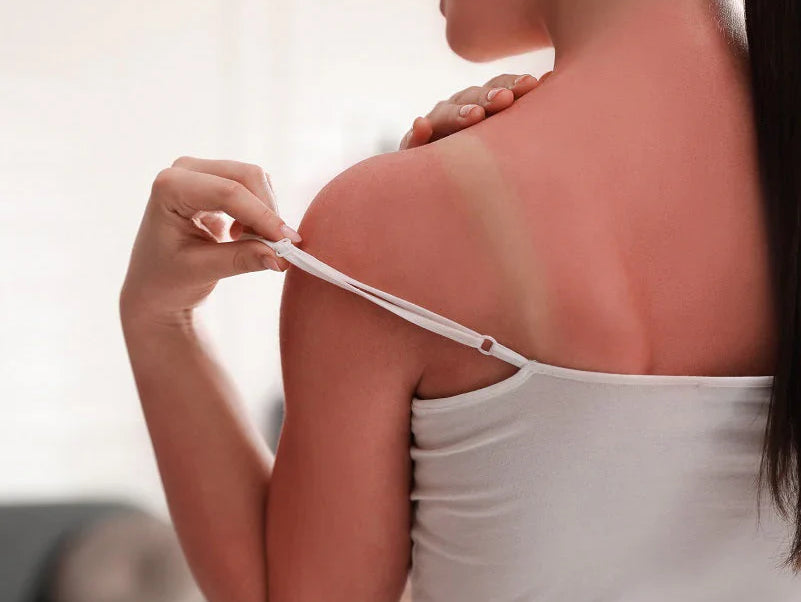 No Sunscreen, No Glow: Why Skipping SPF Isn’t Worth It
