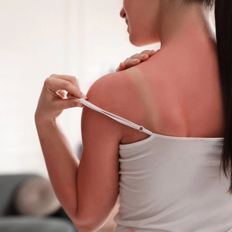 No Sunscreen, No Glow: Why Skipping SPF Isn’t Worth It